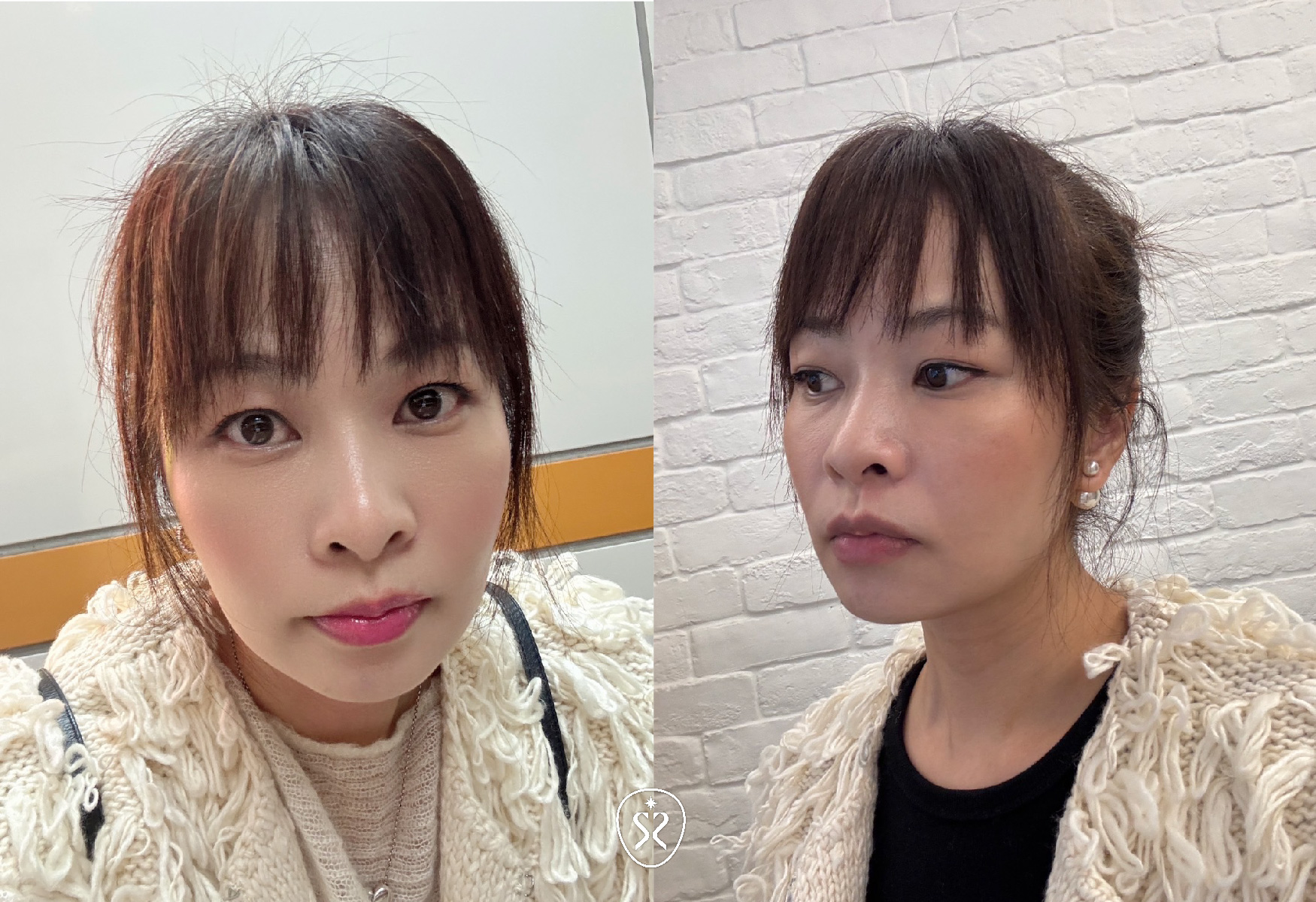 玻尿酸療程可以可改善淚溝、法令紋、臉頰凹陷、夫妻宮填補，也可以進行豐額、隆鼻、豐唇、下巴填充等